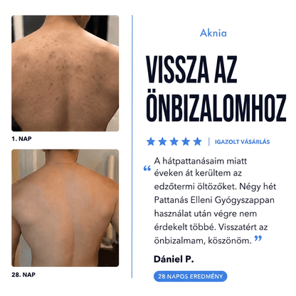 Aknia - Pattanás Elleni Gyógyszappan
